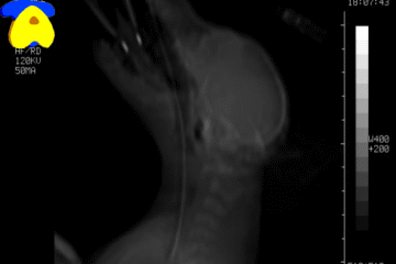 atlantoaxial_subluxation03