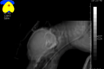 atlantoaxial_subluxation04